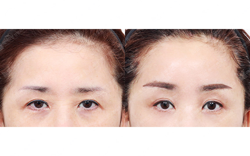 face lifting korea before after pictures - Lifting Before and After