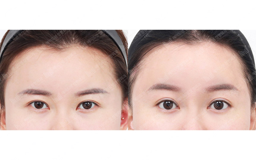face lifting korea before after pictures - Lifting Before and After