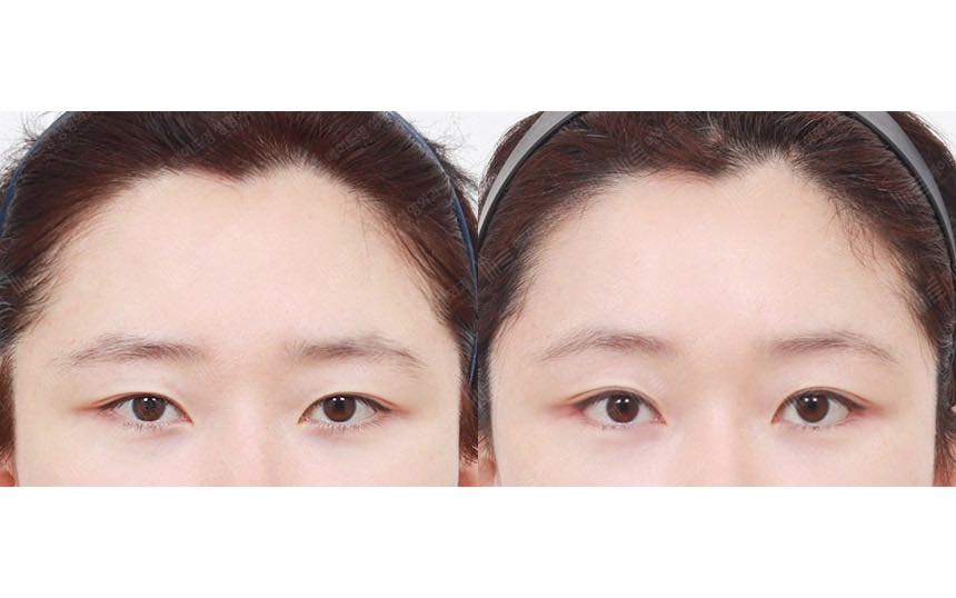 face lifting korea before after pictures - Lifting Before and After
