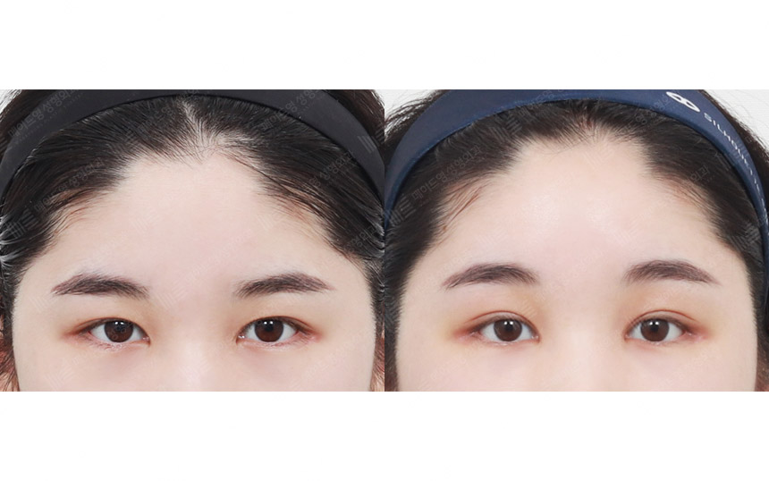 face lifting korea before after pictures - Lifting Before and After