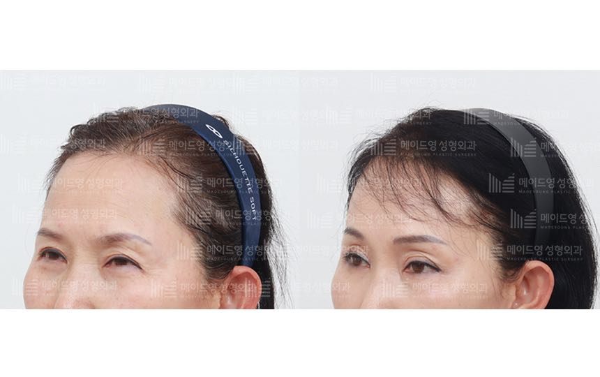 face lifting korea before after pictures - Lifting Before and After