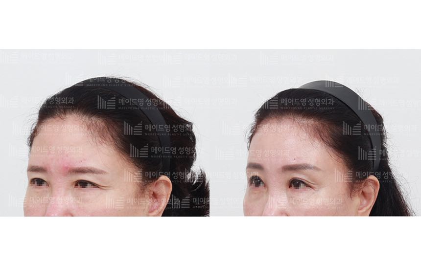 face lifting korea before after pictures - Lifting Before and After