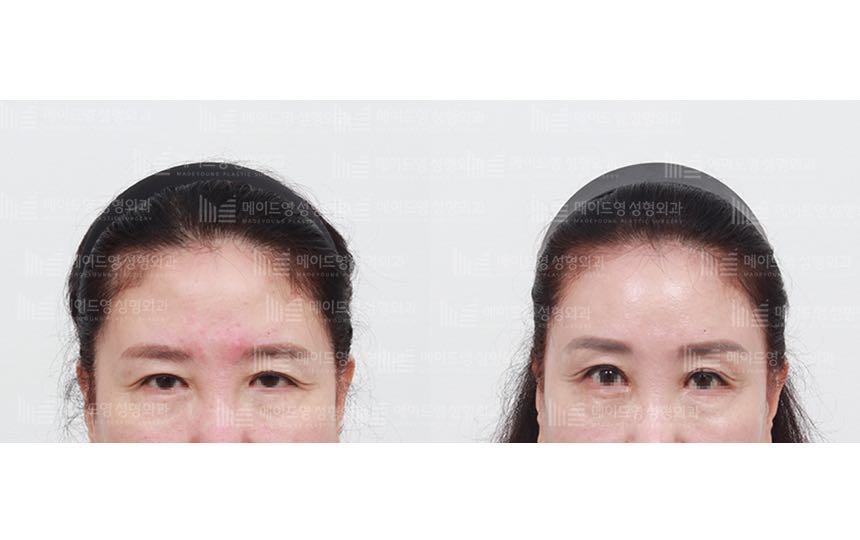 face lifting korea before after pictures - Lifting Before and After