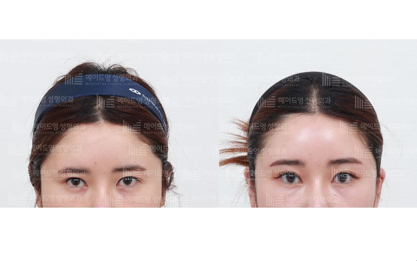 face lifting korea before after pictures - Lifting Before and After