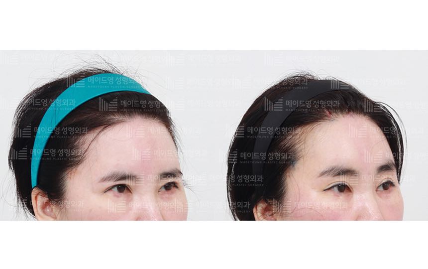 face lifting korea before after pictures - Lifting Before and After