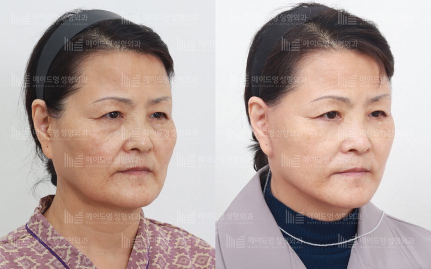 face lifting korea before after pictures - Lifting Before and After