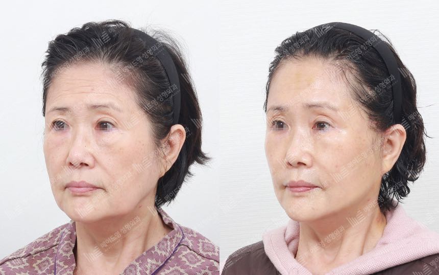 face lifting korea before after pictures - Lifting Before and After