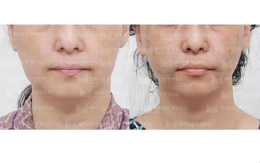 face lifting korea before after pictures - Lifting Before and After