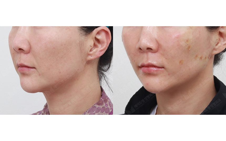 face lifting korea before after pictures - Lifting Before and After