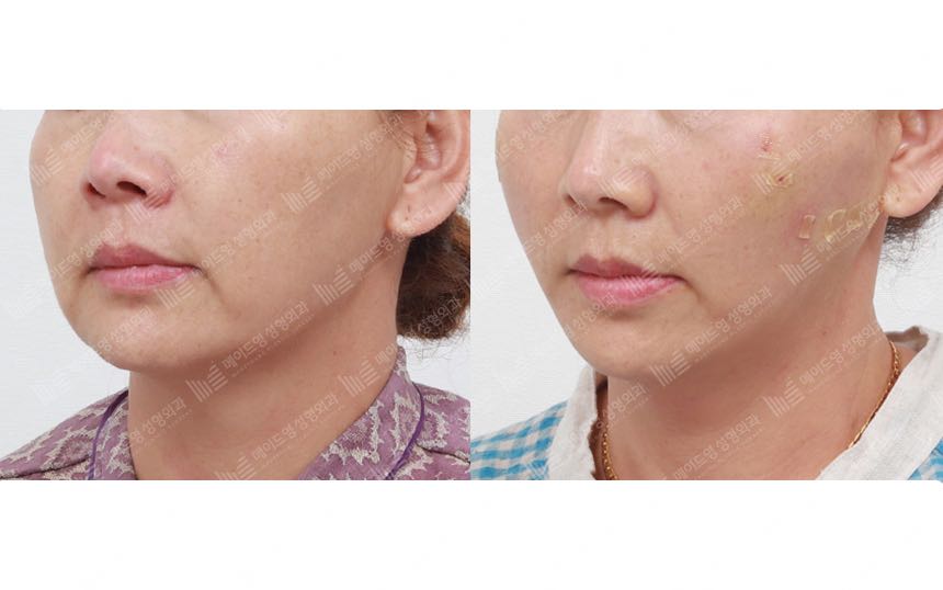 face lifting korea before after pictures - Lifting Before and After