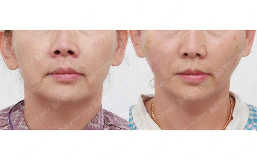 face lifting korea before after pictures - Lifting Before and After