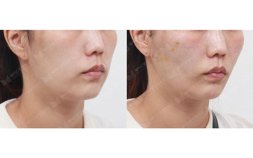 face lifting korea before after pictures - Lifting Before and After