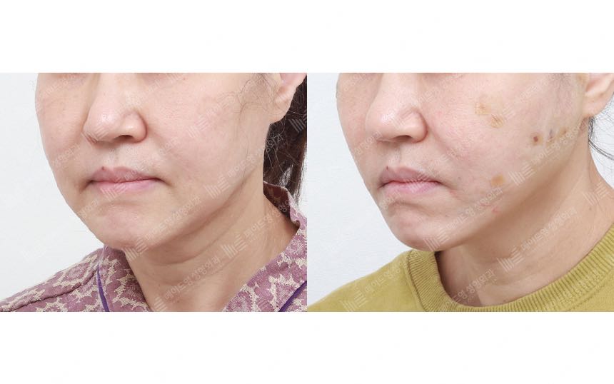 face lifting korea before after pictures - Lifting Before and After