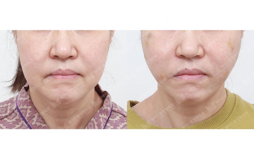 face lifting korea before after pictures - Lifting Before and After