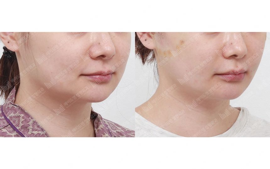 face lifting korea before after pictures - Lifting Before and After