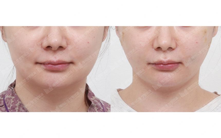face lifting korea before after pictures - Lifting Before and After