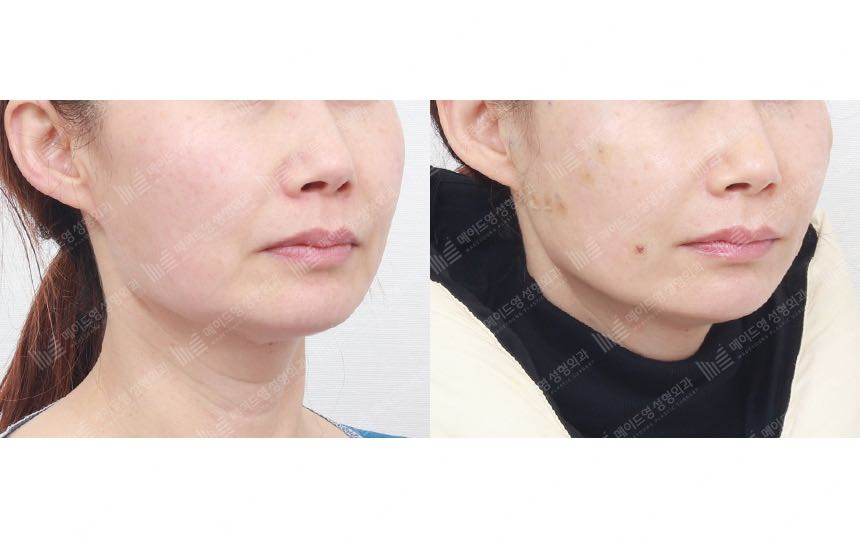 face lifting korea before after pictures - Lifting Before and After