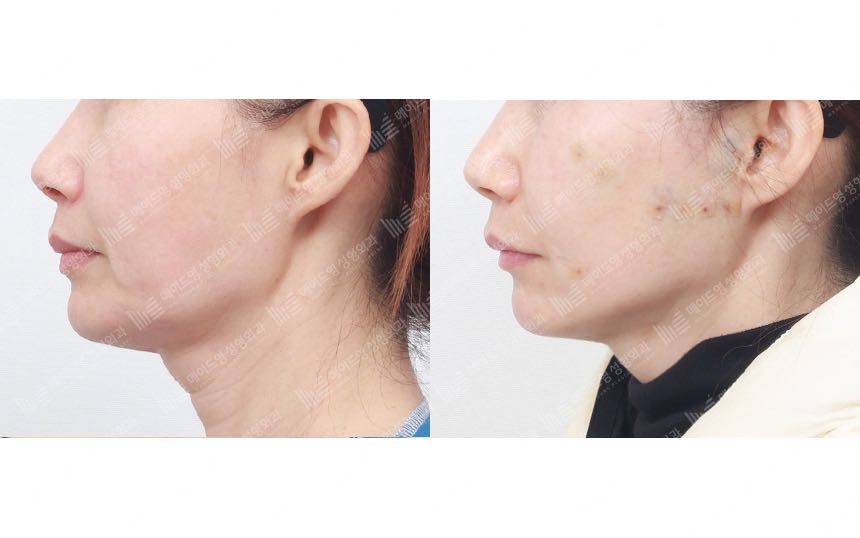 face lifting korea before after pictures - Lifting Before and After