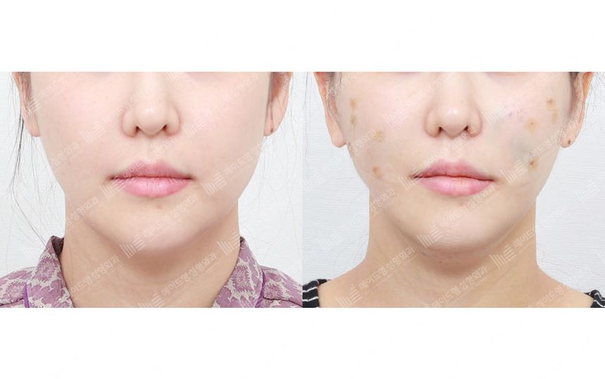 face lifting korea before after pictures - Lifting Before and After
