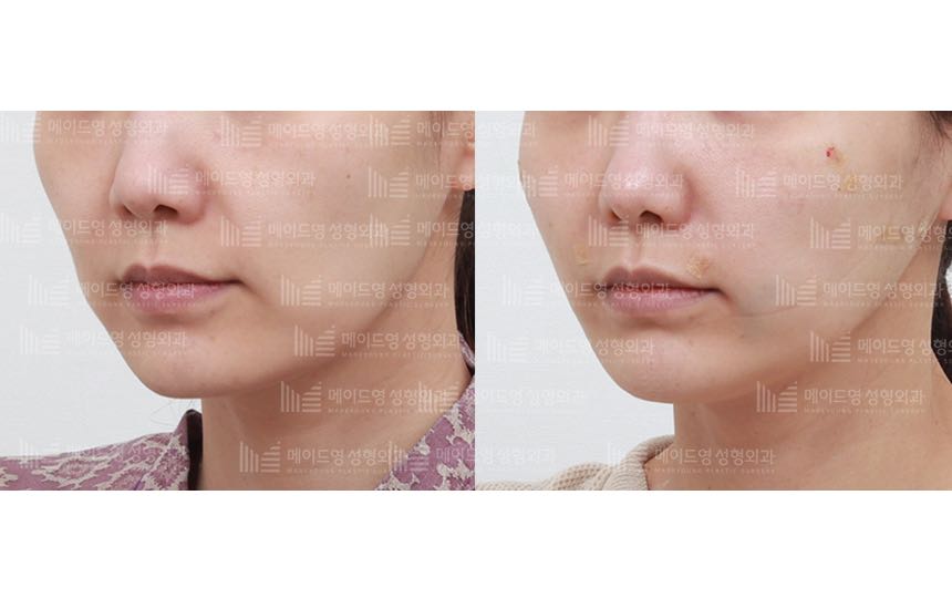 face lifting korea before after pictures - Lifting Before and After