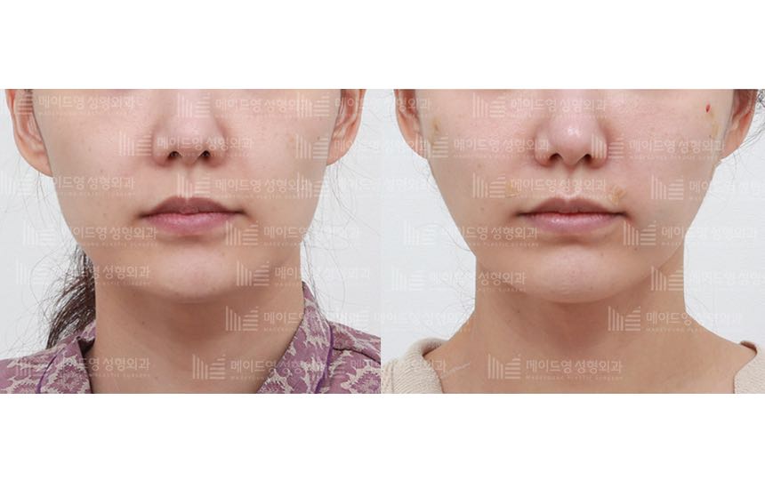 face lifting korea before after pictures - Lifting Before and After