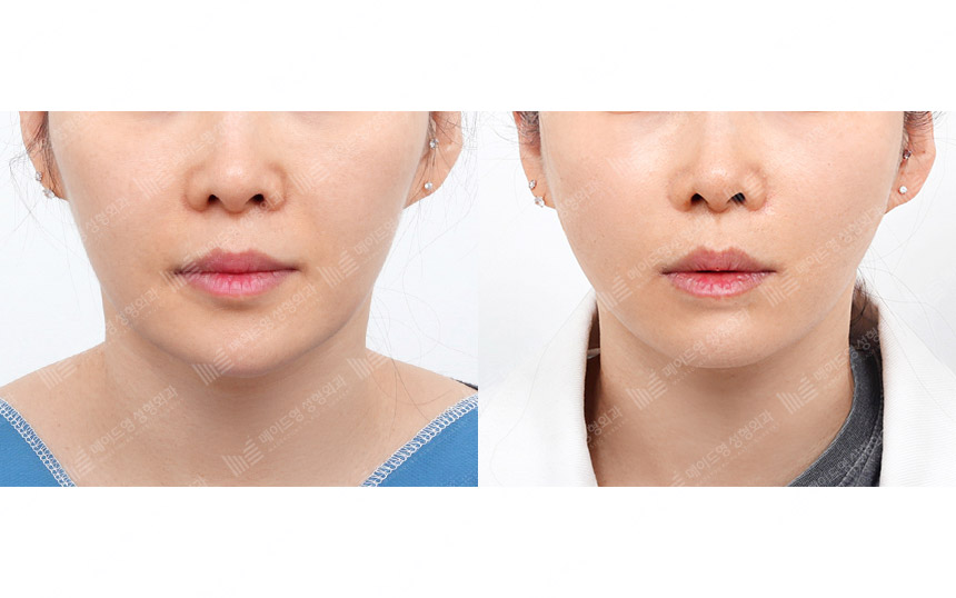 face lifting korea before after pictures - Lifting Before and After