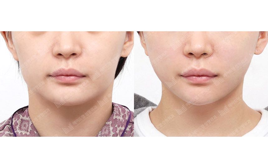 face lifting korea before after pictures - Lifting Before and After