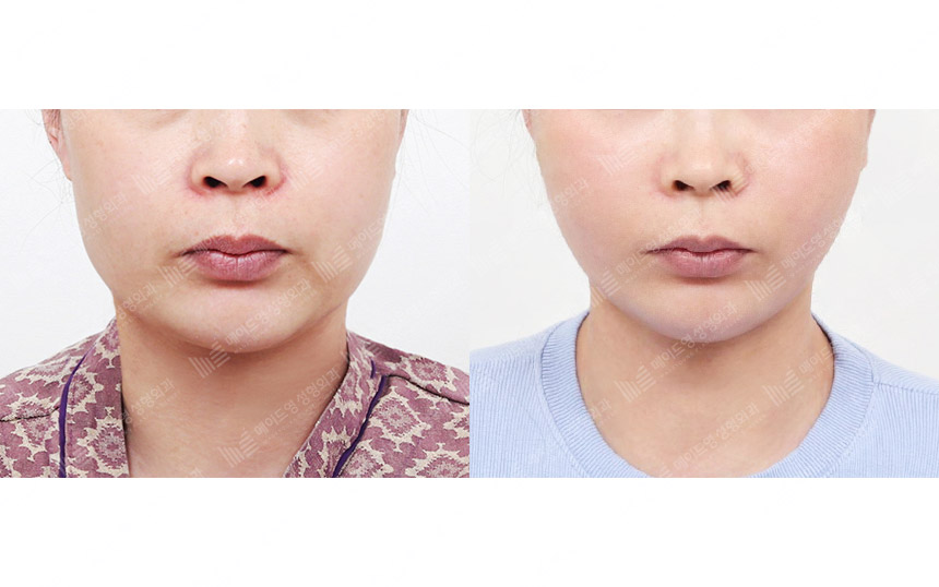 face lifting korea before after pictures - Lifting Before and After