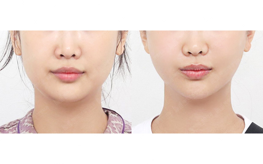 face lifting korea before after pictures - Lifting Before and After