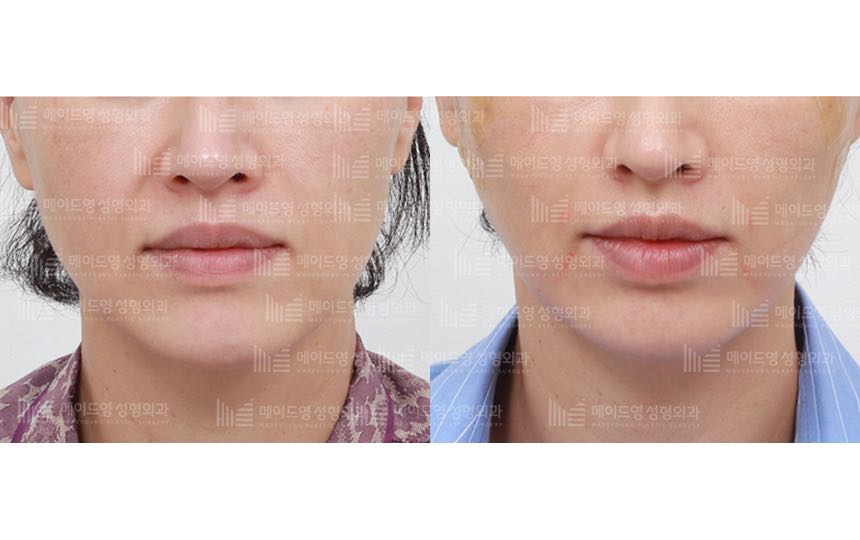 face lifting korea before after pictures - Lifting Before and After