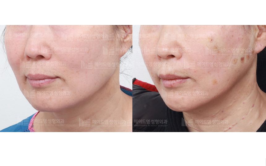 face lifting korea before after pictures - Lifting Before and After