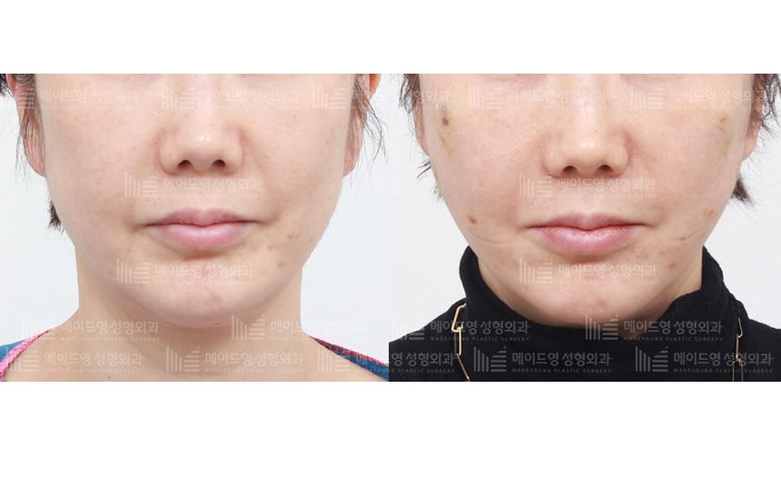 face lifting korea before after pictures - Lifting Before and After