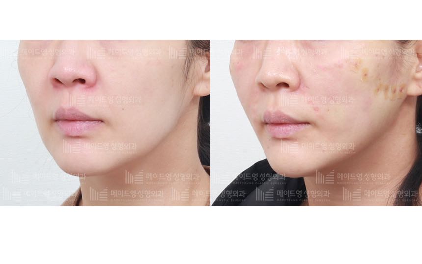 face lifting korea before after pictures - Lifting Before and After