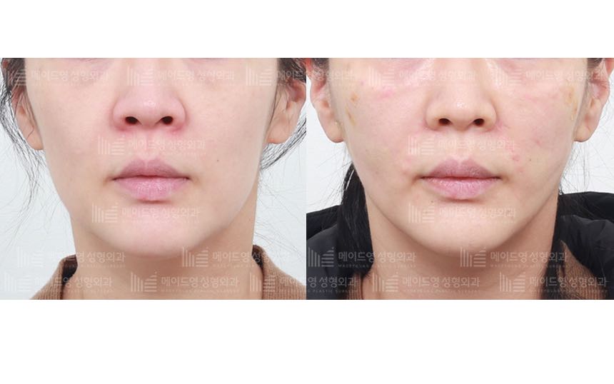 face lifting korea before after pictures - Lifting Before and After
