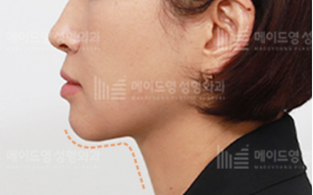 made young double chin lift in korea