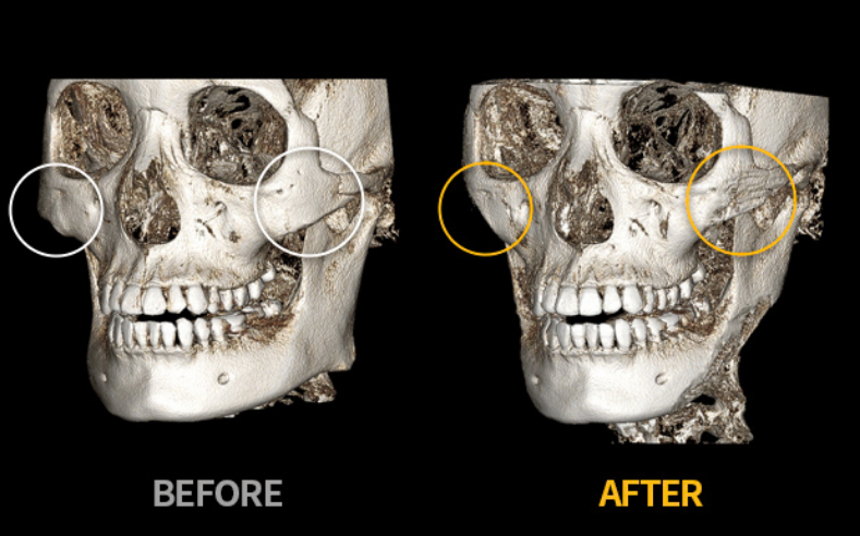 cheekbone reduction in korea made young