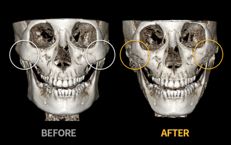 cheekbone reduction in korea made young