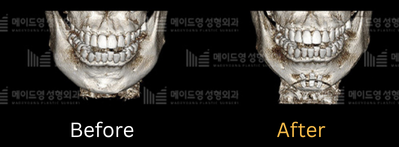 chin surgery genioplasty in korea made young