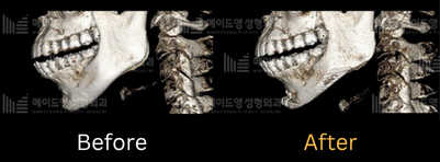 chin surgery genioplasty in korea made young