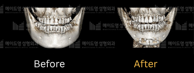 chin surgery genioplasty in korea made young