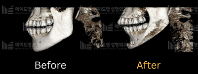 chin surgery genioplasty in korea made young
