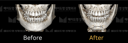 chin surgery genioplasty in korea made young