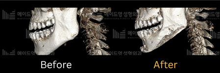 chin surgery genioplasty in korea made young