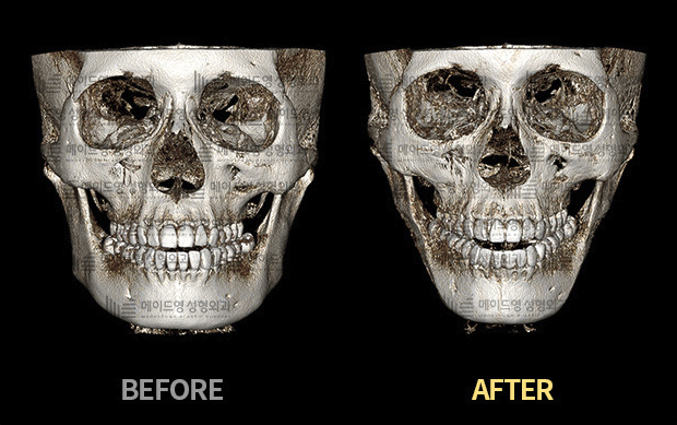 jaw reduction surgery in korea made young