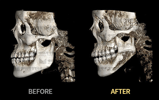 jaw reduction surgery in korea made young