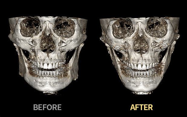 jaw reduction surgery in korea made young