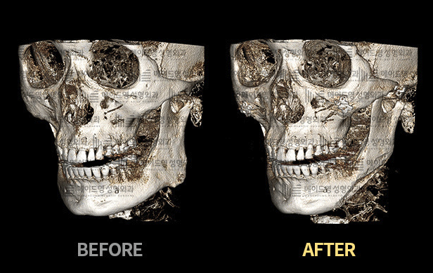 jaw reduction surgery in korea made young