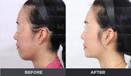 chin surgery genioplasty in korea made young