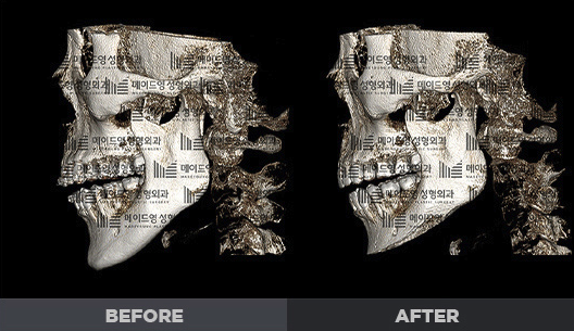 chin surgery genioplasty in korea made young