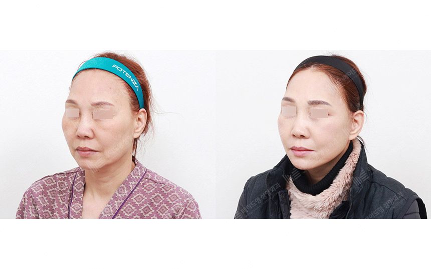 face lifting korea before after pictures - Lifting Before and After